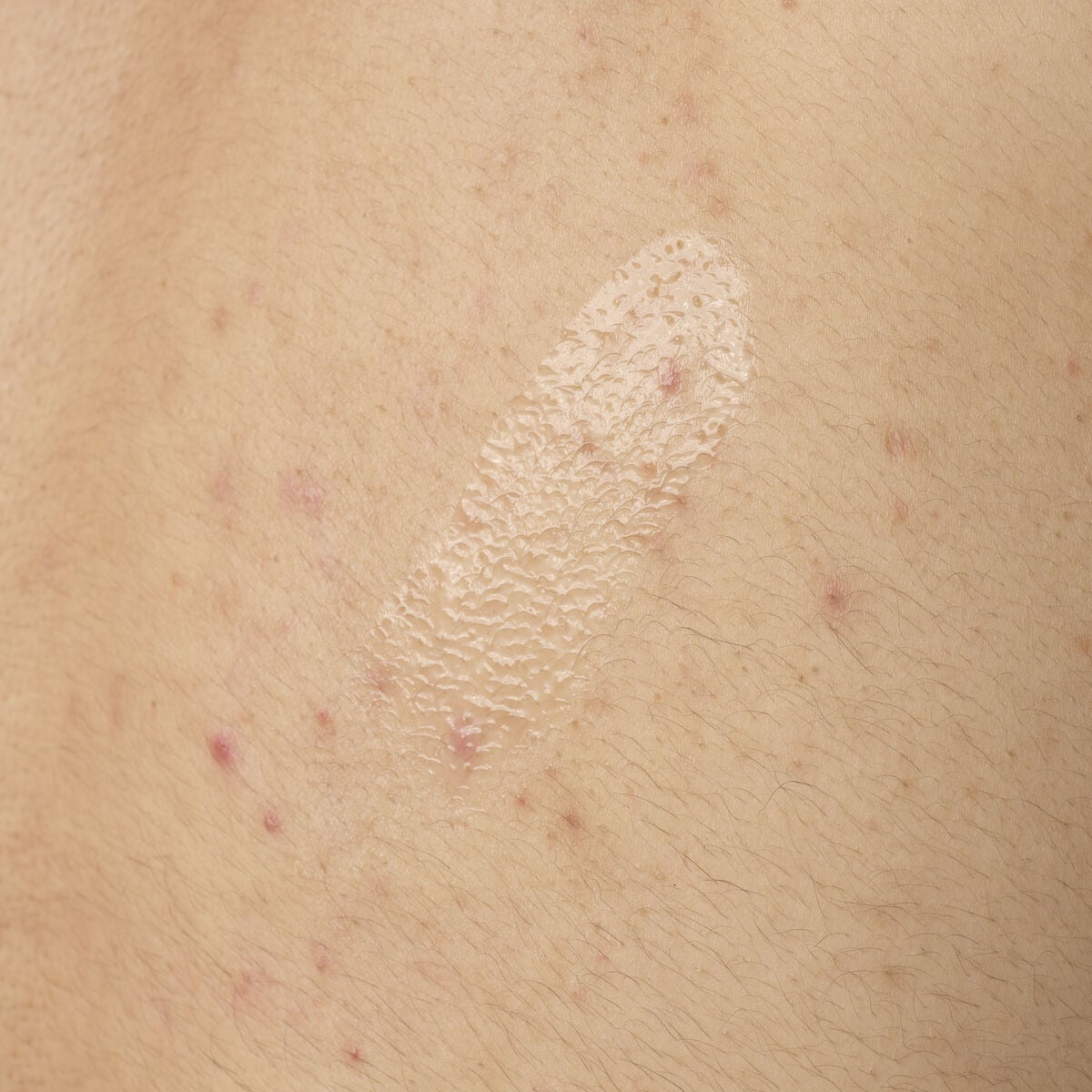 salicylic-acid-0-5-body-serum-p9 ORD-salicylic-acid-05-body-240ml-application.jpg