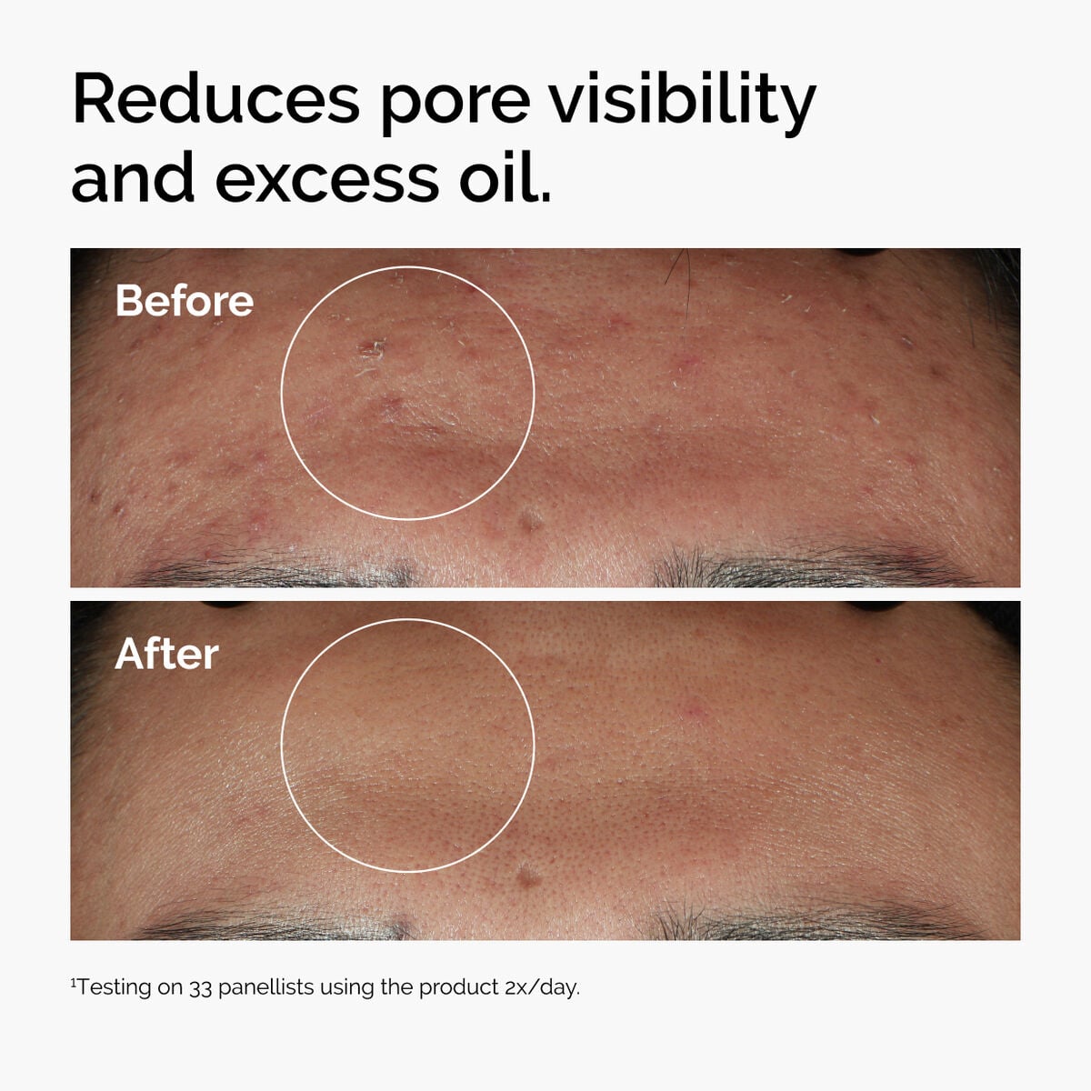 niacinamide-10-zinc-1-l0 ord-niacinamide-zinc-blemish-serum-before-after-pores.jpg