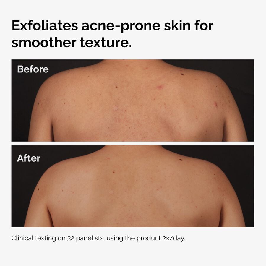 the-body-care-collection-x7 ord-salicylic-acid-body-serum-before-after-graphic-NA.jpg